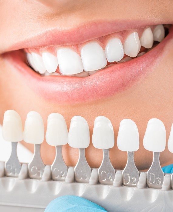 Blanqueamiento Dental